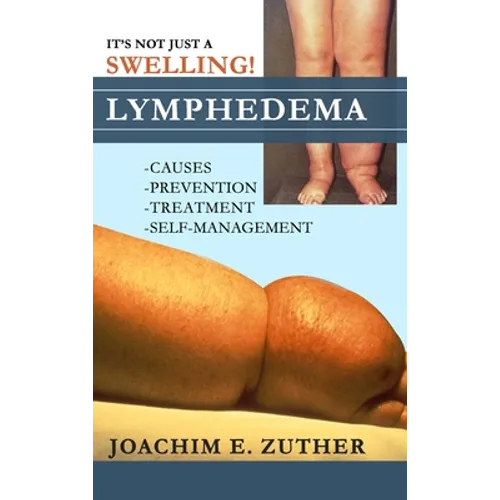 It's Not Just a Swelling! Lymphedema: Causes, Prevention, Treatment, Self-Management