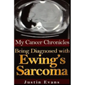 My Cancer Chronicles: Being Diagnosed with Ewing's Sarcoma